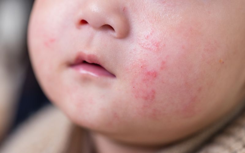 Closeup of infant with eczema skin condition